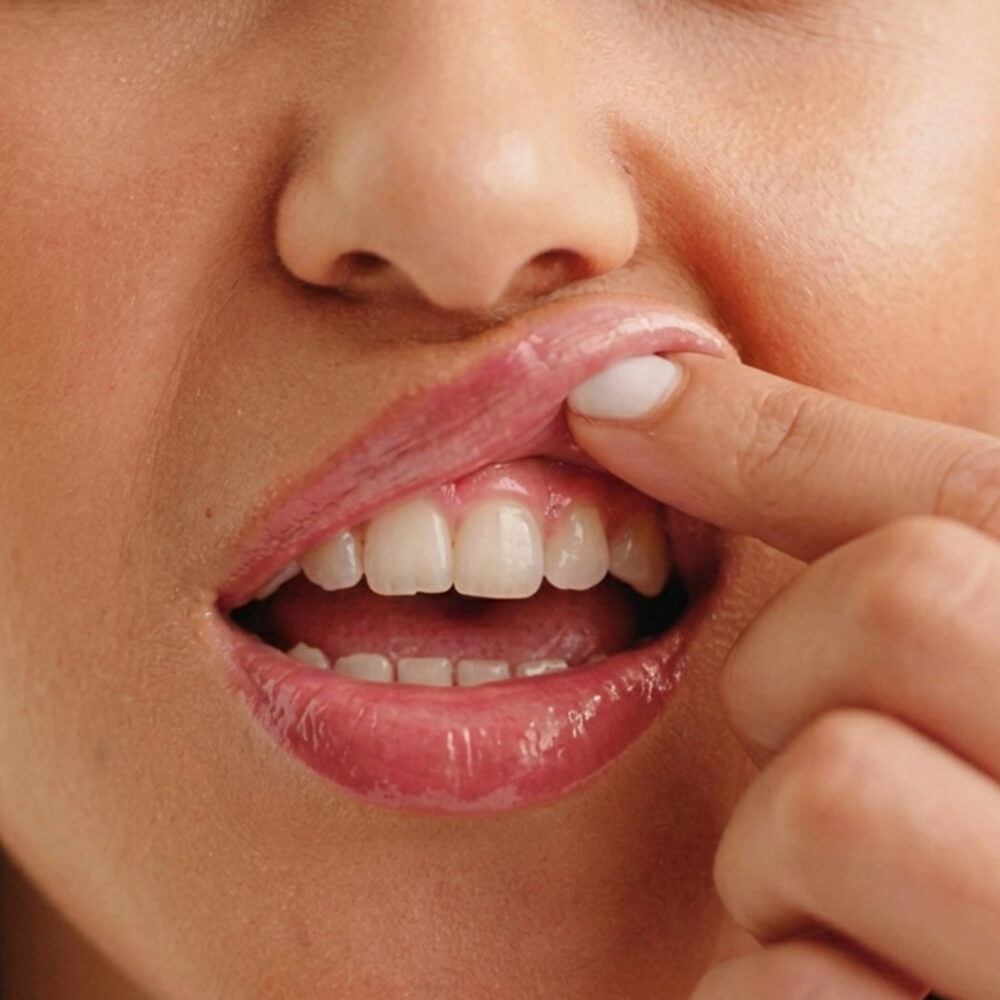 Tartar vs Plaque comparison showing the difference between healthy teeth and yellow calculus buildup along the gum line